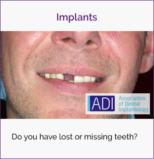 Dental Implants | Stuart Steven Edinburgh