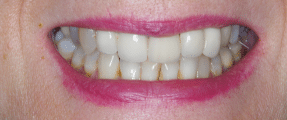 Smile Makeover - More Extensive - Before - Edinburgh Dentist