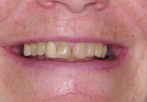 Smile Makeover - Full Mouth- 1 - Edinburgh Dentist