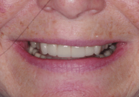 Smile Makeover - Full Mouth- 2 - Edinburgh Dentist
