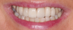 Smile Makeover - More Extensive - After - Edinburgh Dentist