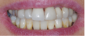 Smile Makeover - More Extensive - Before - Edinburgh Dentist