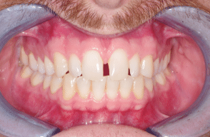 Teeth withening - Case Two - Before