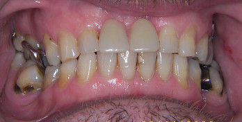 After denture treatment - Edinburgh Dentist